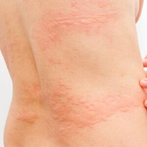 Allergy