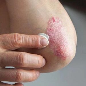 Psoriasis