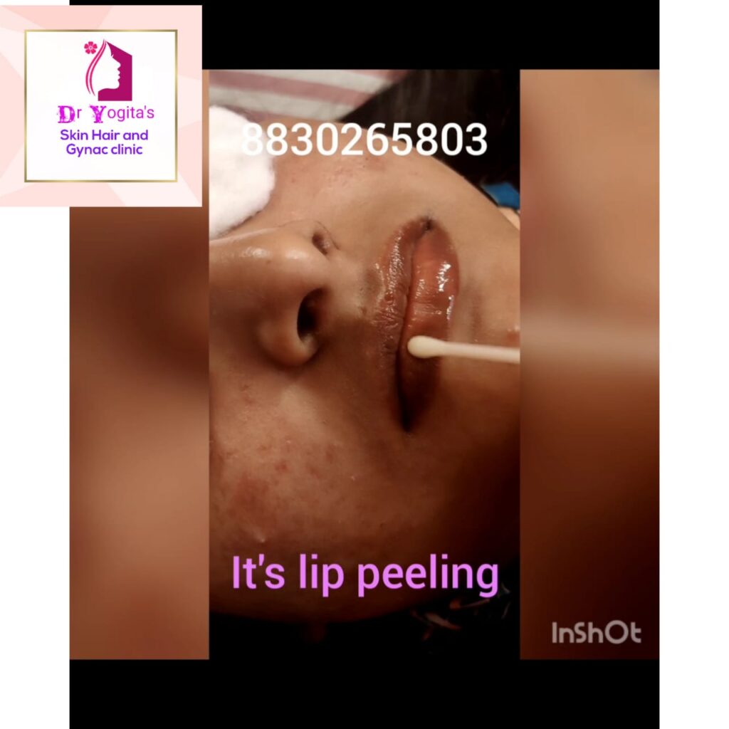 Lip Peeling Treatment