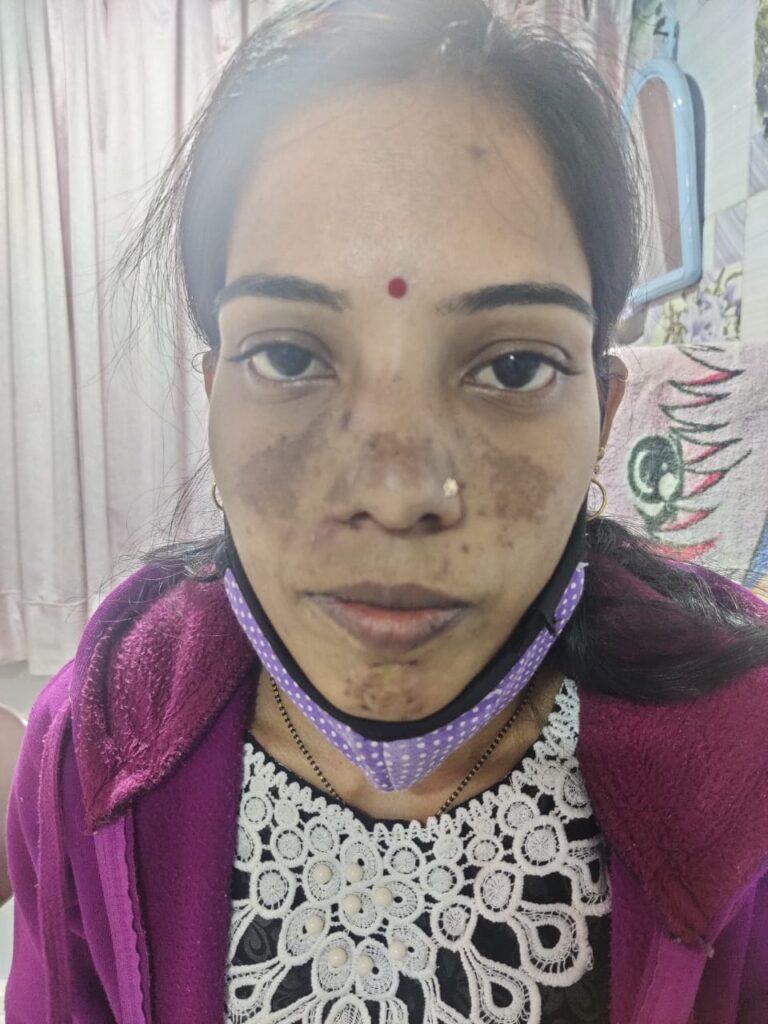Melasma / वंग Treatment