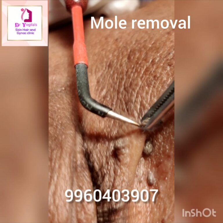 Mole Removal Procedure