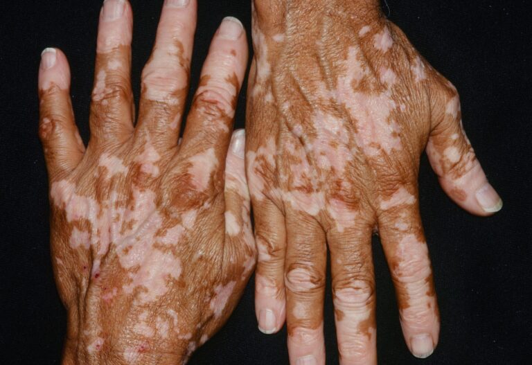 Vitiligo / कोड
