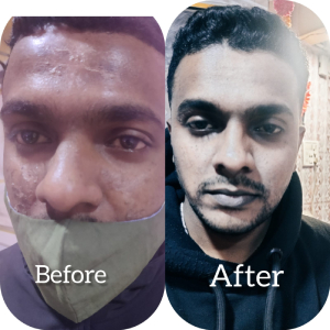 HydraFacial Treatment