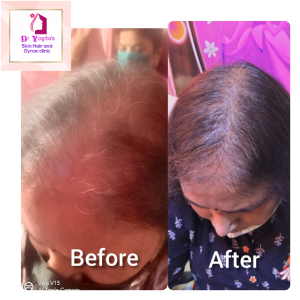Hair Regrowth Treatment