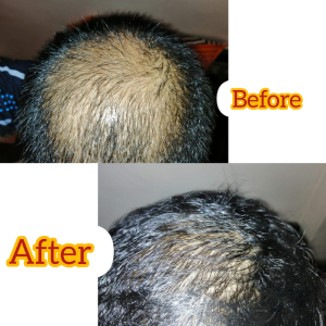 Hair Loss Treatment