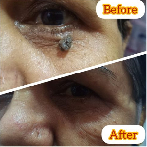 Mole Treatment