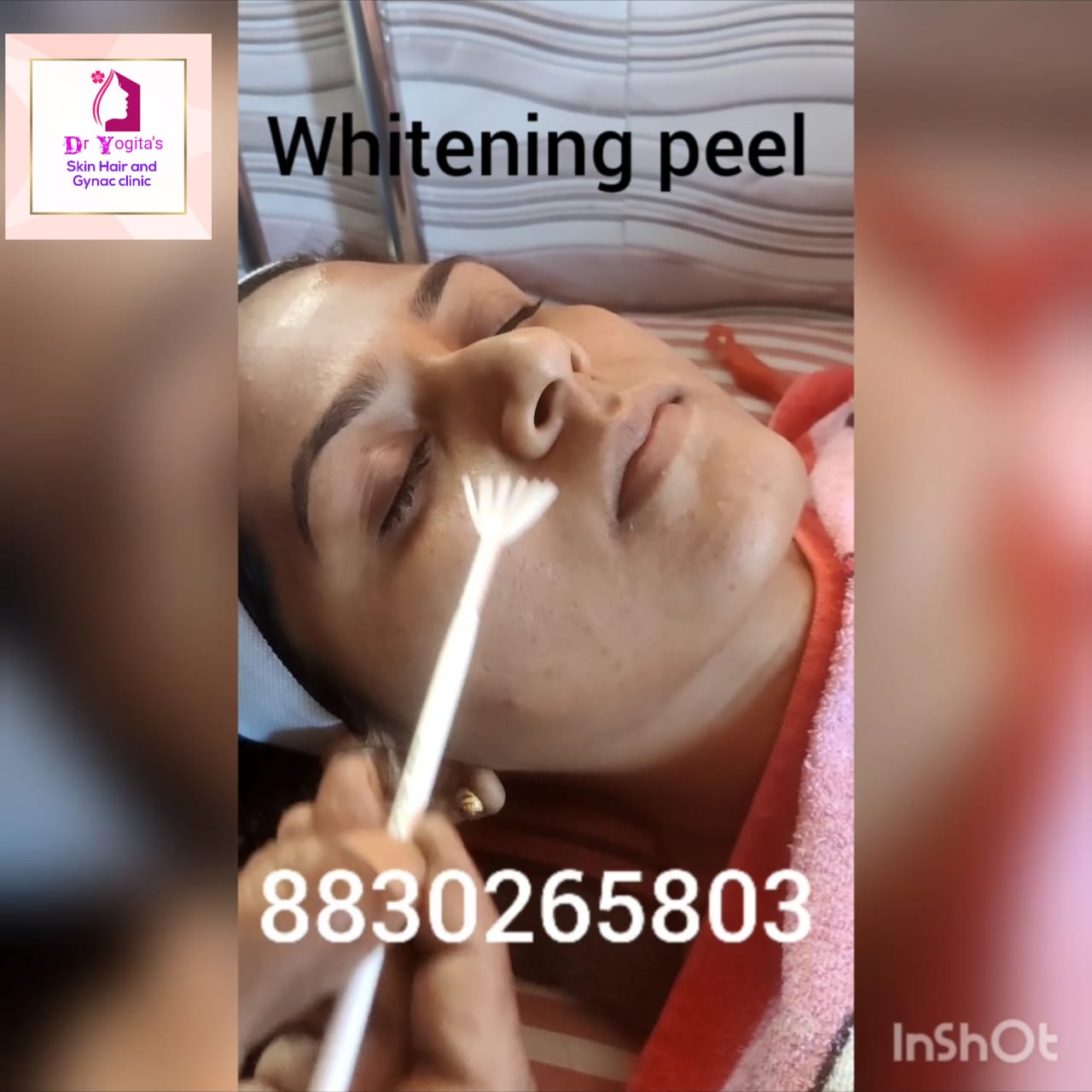 Whitening Peel Treatment